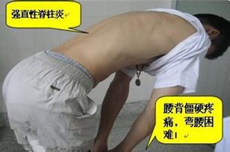青少年强直性脊柱炎典型症状表现 青少年强直性脊柱炎典型症状表现