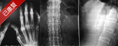 患者手指关节及腰部症状CT显示 患者手指关节及腰部症状CT显示